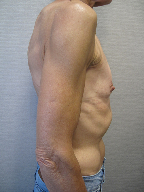 Patiente 10 - augmentation mammaire protheses avant