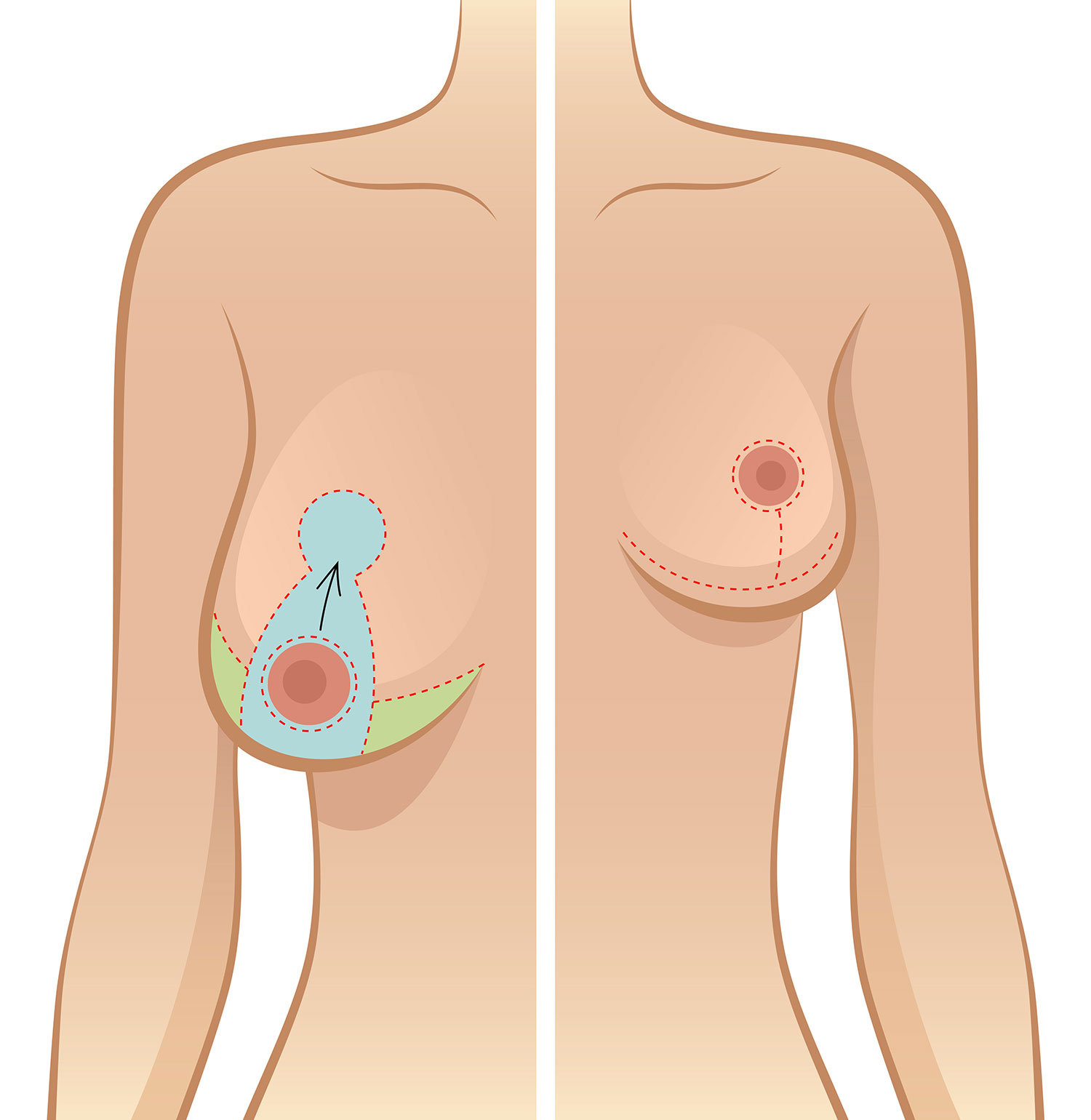 Ptose mammaire