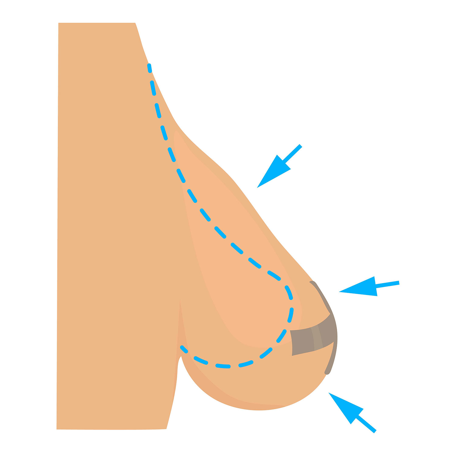 Réduction mammaire Gestes