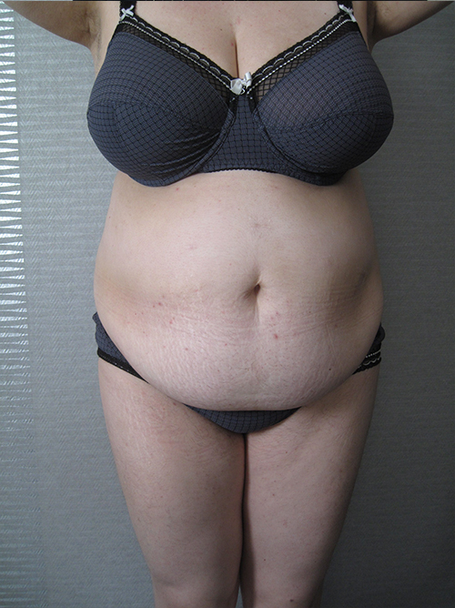 Patiente 18 - Abdominoplastie avant