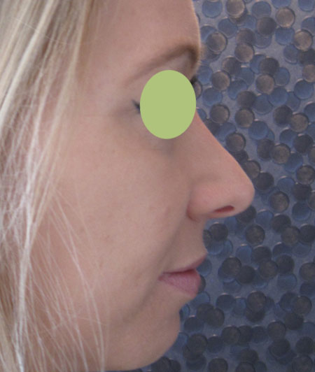Patiente 2 - Rhinoplastie après