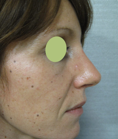 Patiente 3 - Rhinoplastie après