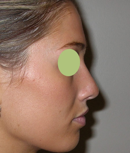 Patiente 3 - Rhinoplastie après