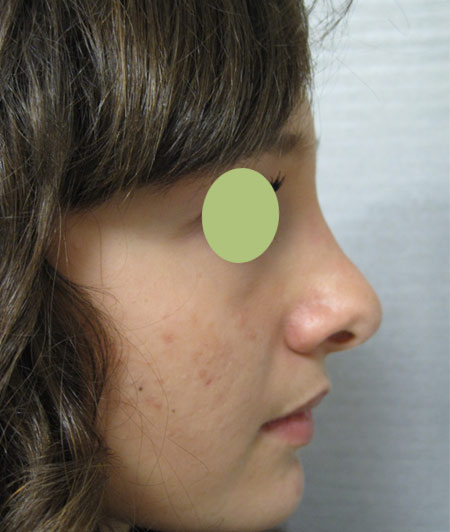 Patiente 3 - Rhinoplastie après