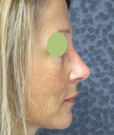 Patiente 6 - Rhinoplastie après