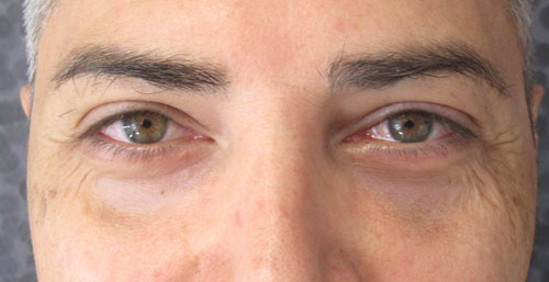 Patiente 15 - blepharoplastie après