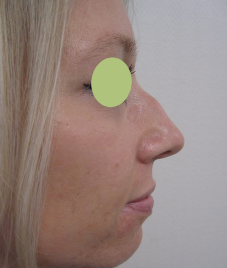 Patiente 2 - Rhinoplastie avant