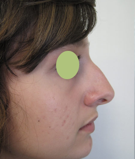 Patiente 3 - Rhinoplastie avant