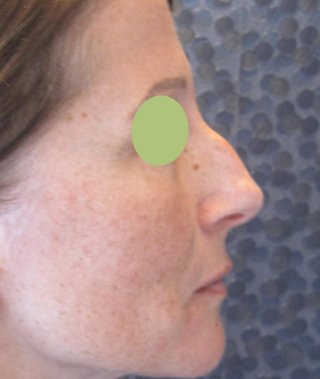 Patiente 6 - Rhinoplastie avant