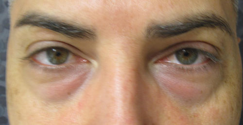 Patient 15 - blepharoplastie avant