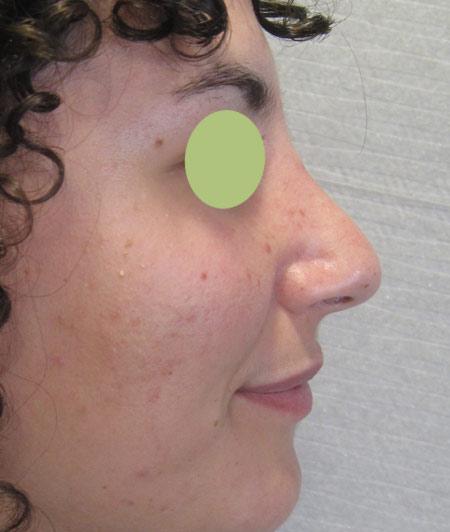 Patiente 1 - Rhinoplastie après