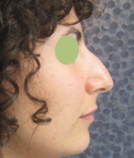 Patiente 1 - Rhinoplastie avant