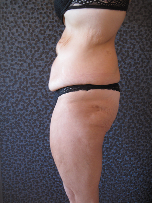 Avant Abdominoplastie - Patiente 2 de profile