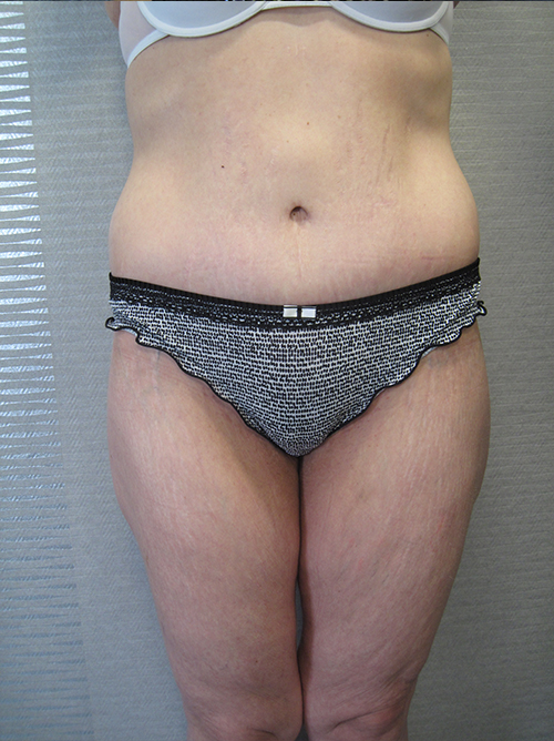 Après Abdominoplastie - Patiente 3 de face