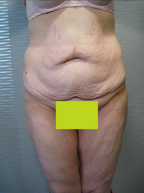 Avant Abdominoplastie - Patiente 3 de face