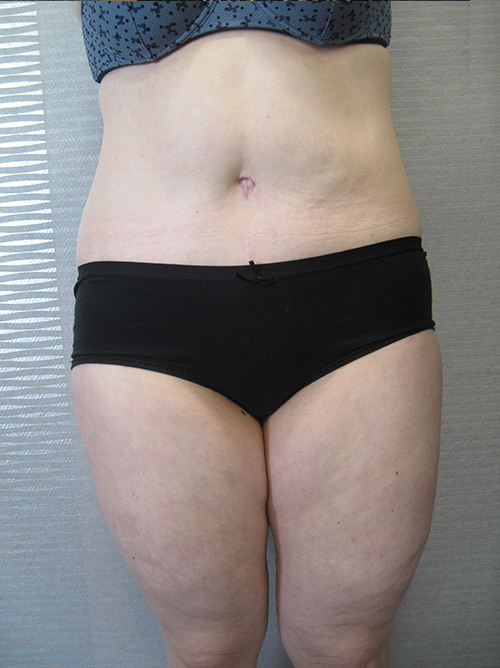 Après Abdominoplastie - Patiente 2 de face