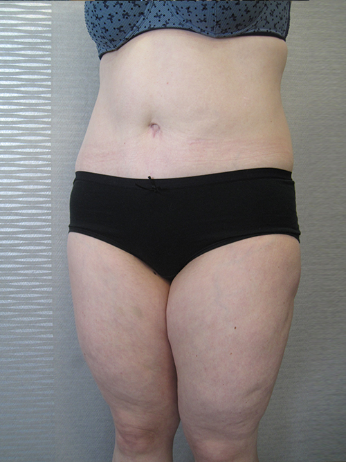 Après Abdominoplastie - Patiente 4 de profile