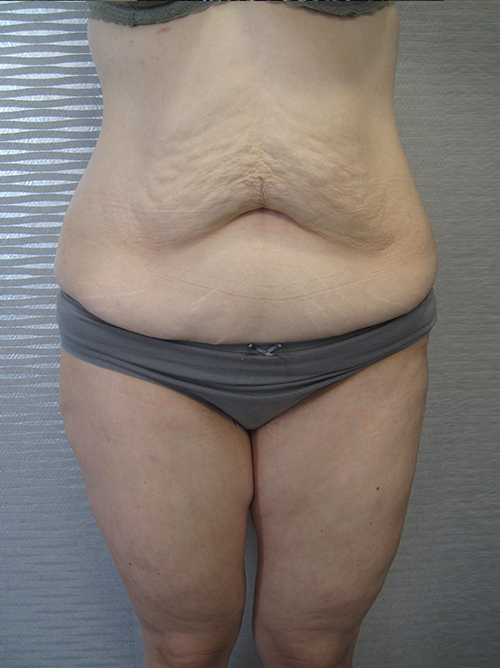 Avant Abdominoplastie - Patiente 4 de face