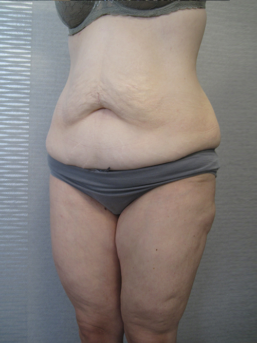 Avant Abdominoplastie - Patiente 4 de profile