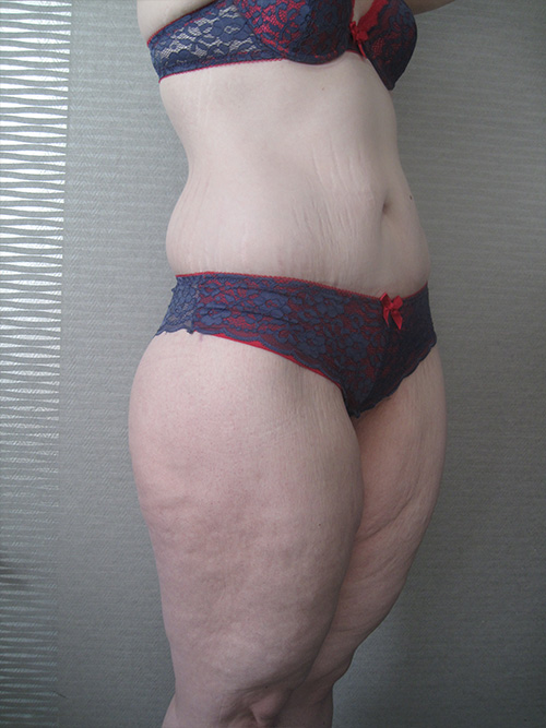 Après Abdominoplastie - Patiente 2 de profile