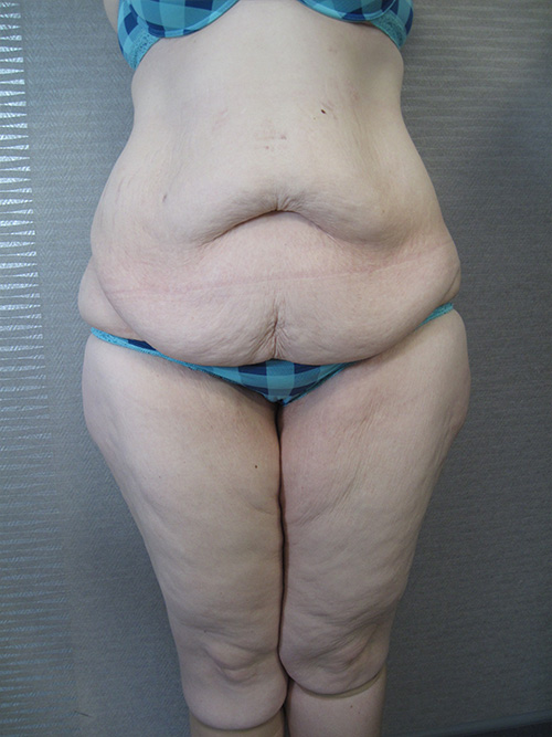 Avant Abdominoplastie - Patiente 2 de face