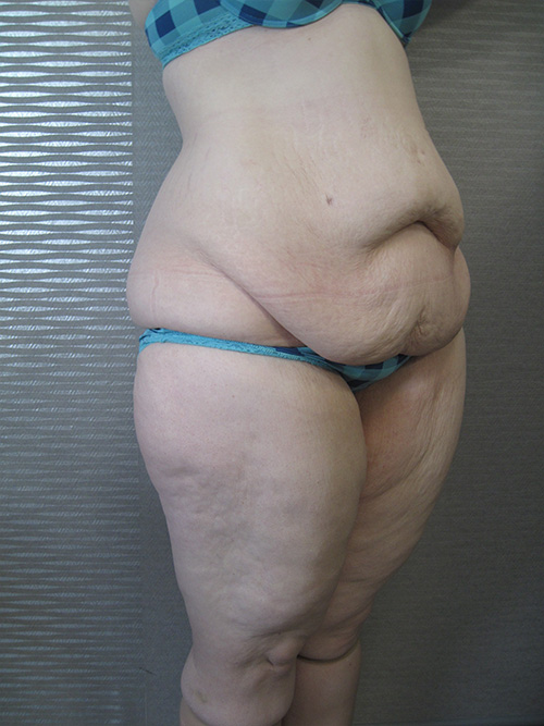 Avant Abdominoplastie - Patiente 2 de profile