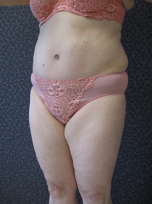 Après Abdominoplastie - Patiente 1 de profile