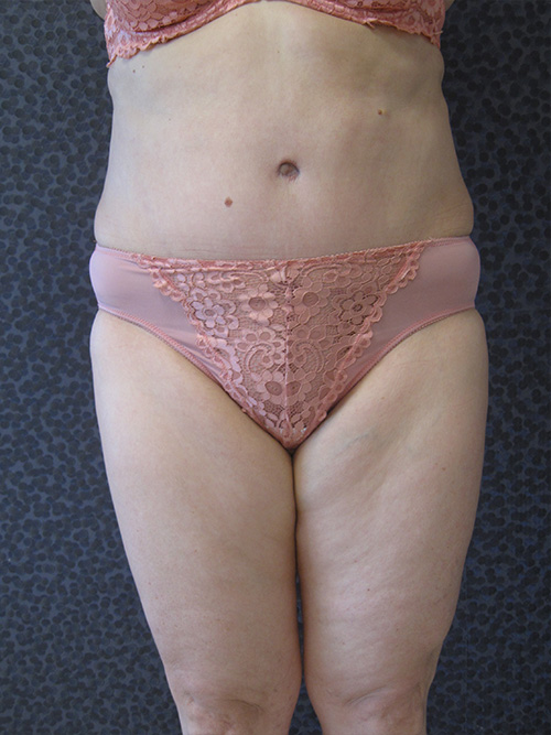 Après Abdominoplastie - Patiente 1 de face