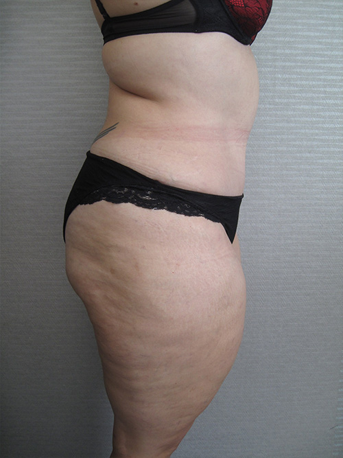 Après Abdominoplastie - Patiente 1 de profile