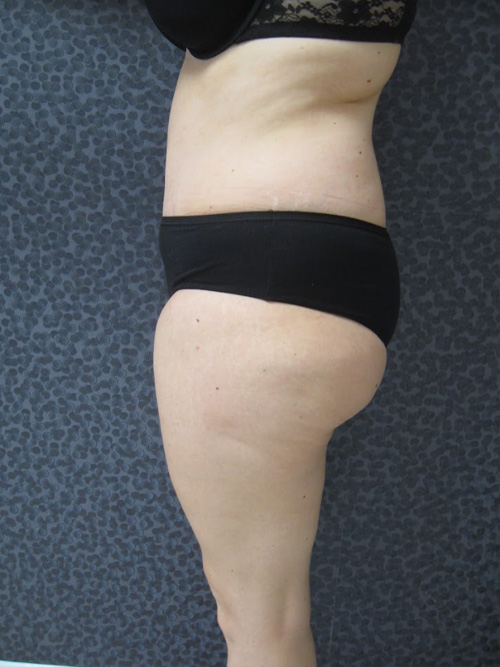 Après Abdominoplastie - Patiente 1 de profile