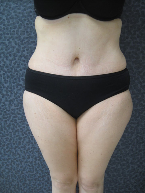 Après Abdominoplastie - Patiente 1 de face