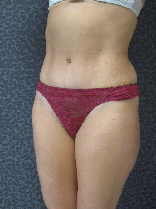 Après Abdominoplastie - Patiente 1 de profile