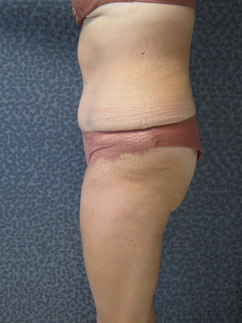 Après Abdominoplastie - Patiente 1 de profile