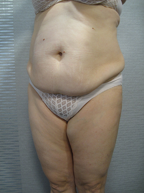 Avant Abdominoplastie - Patiente 1 de profile