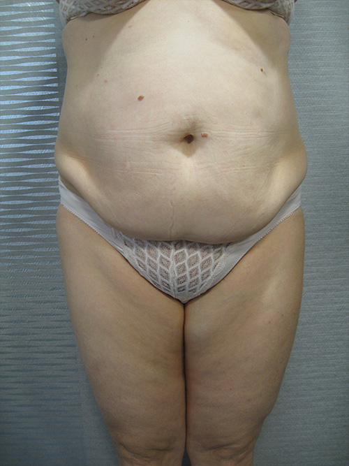 Avant Abdominoplastie - Patiente 1 de face