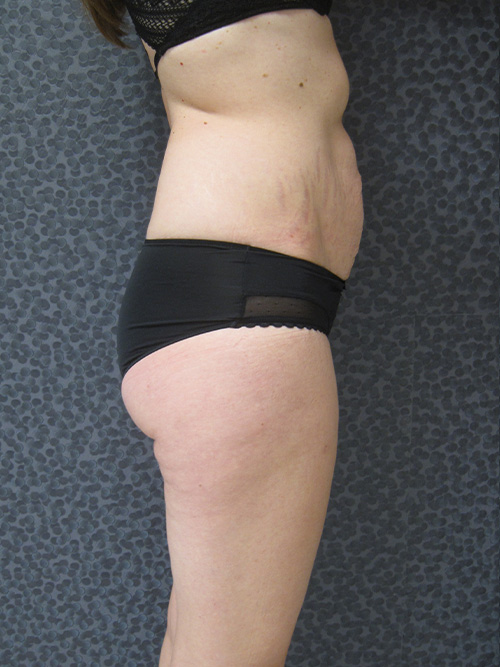 Avant Abdominoplastie - Patiente 1 de profile