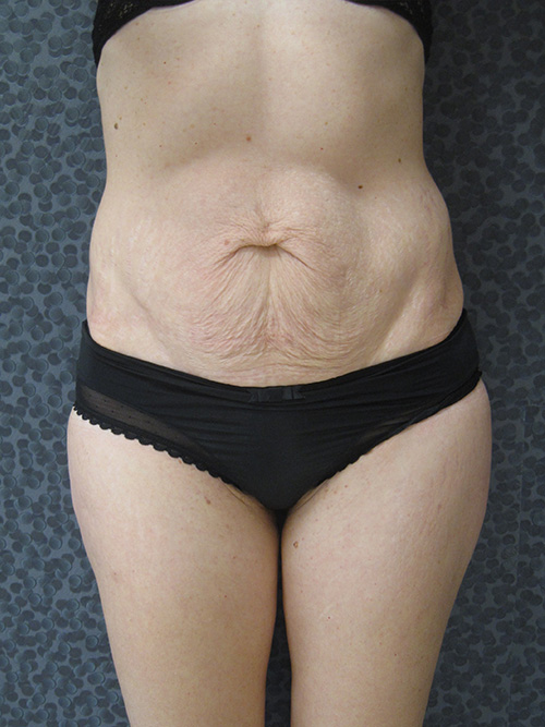 Avant Abdominoplastie - Patiente 1 de face