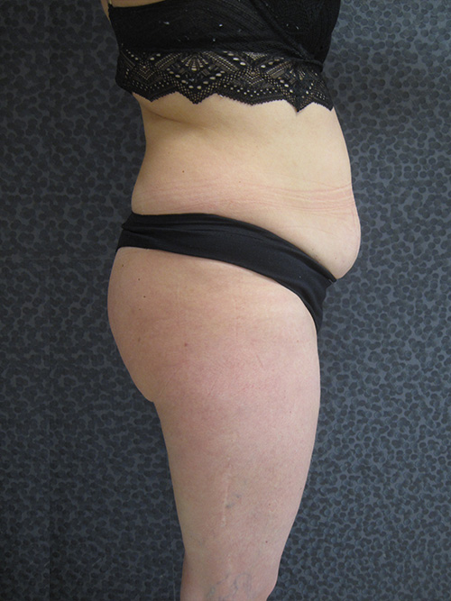 Avant Abdominoplastie - Patiente 1 de profile