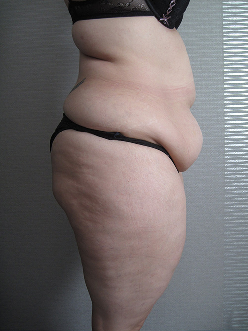 Avant Abdominoplastie - Patiente 1 de profile