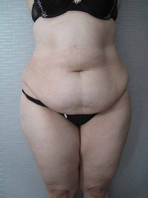 Avant Abdominoplastie - Patiente 1 de face