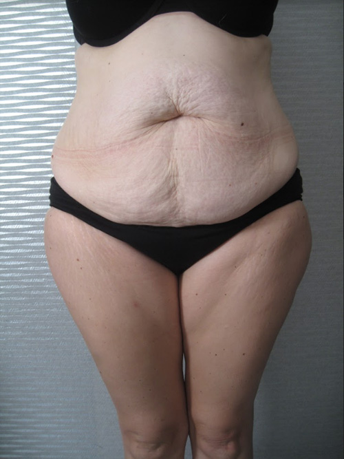 Avant Abdominoplastie - Patiente 1 de face