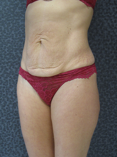 Avant Abdominoplastie - Patiente 1 de profile