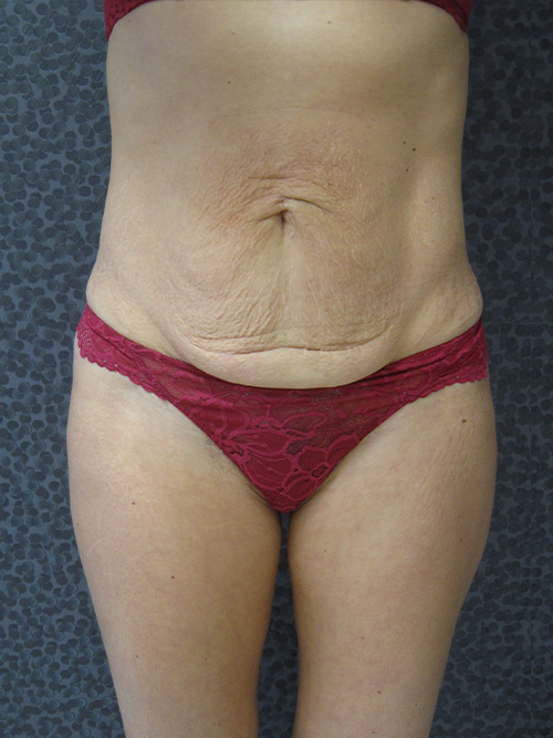 Avant Abdominoplastie - Patiente 1 de face