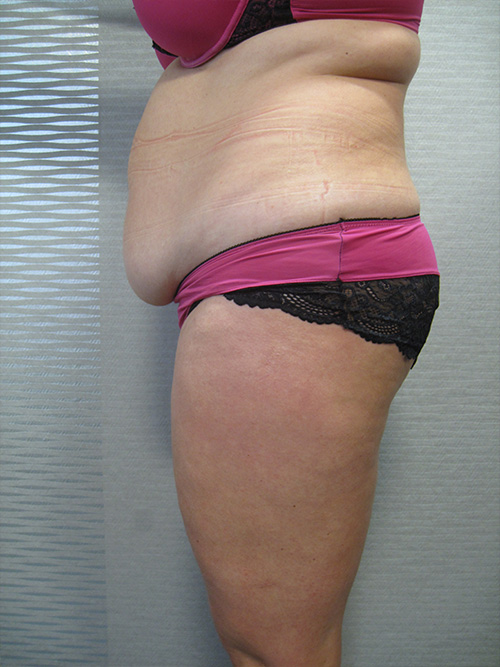 Avant Abdominoplastie - Patiente 1 de profile