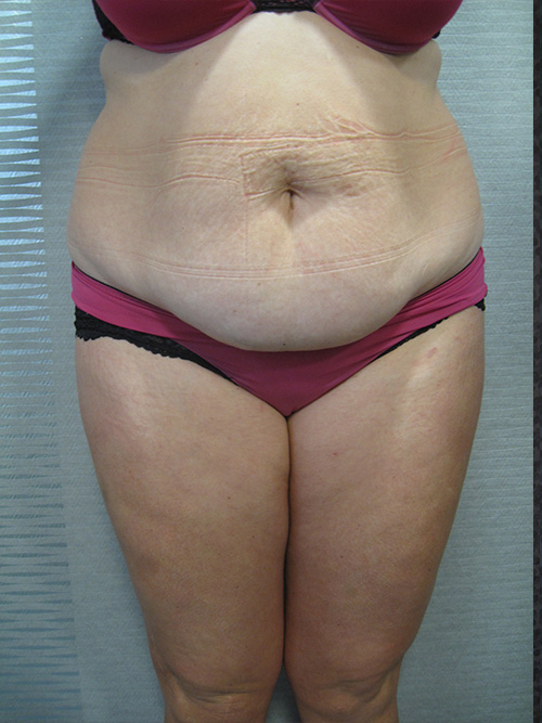 Avant Abdominoplastie - Patiente 1 de face