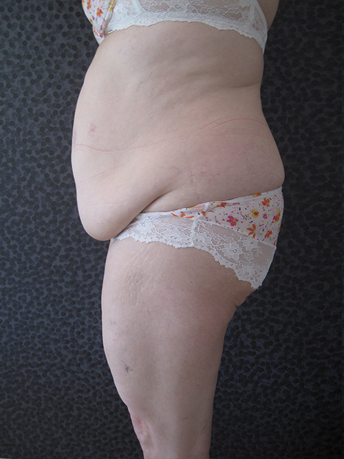 Avant Abdominoplastie - Patiente 1 de profile