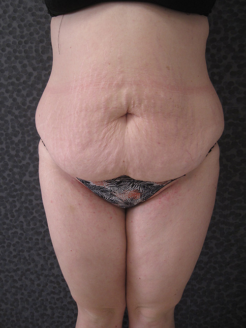 Avant Abdominoplastie - Patiente 1 de face