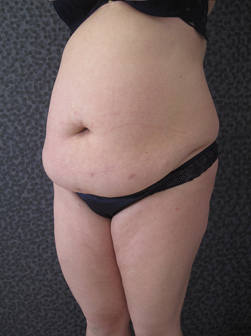 Avant Abdominoplastie - Patiente 1 de profile