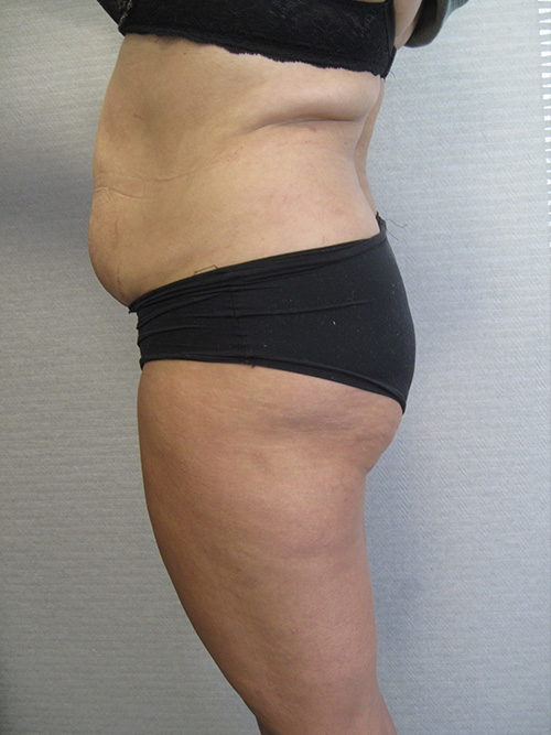 Avant Abdominoplastie - Patiente 1 de profile