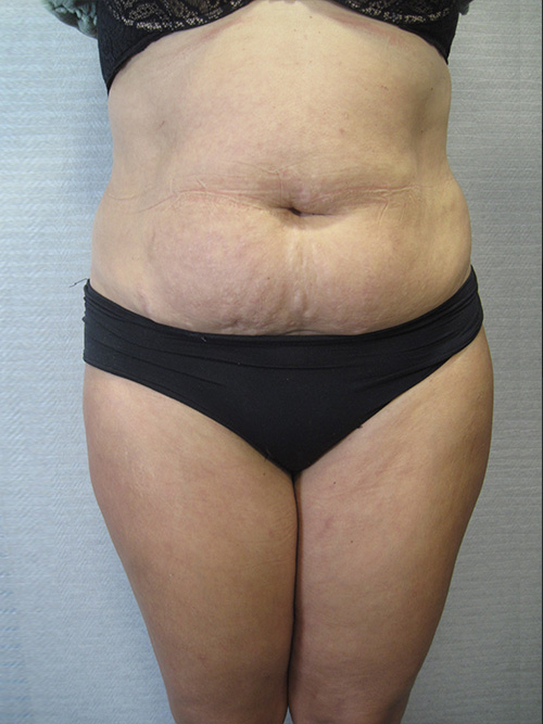 Avant Abdominoplastie - Patiente 1 de face